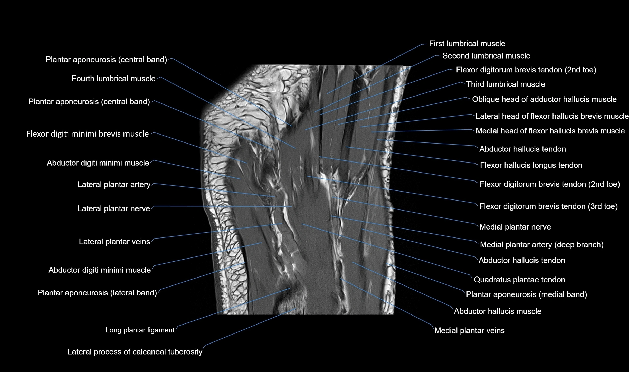 MRI mid foot coronal ligaments cross sectional anatomy 3T  radiology  image-img-00001-00033.webp